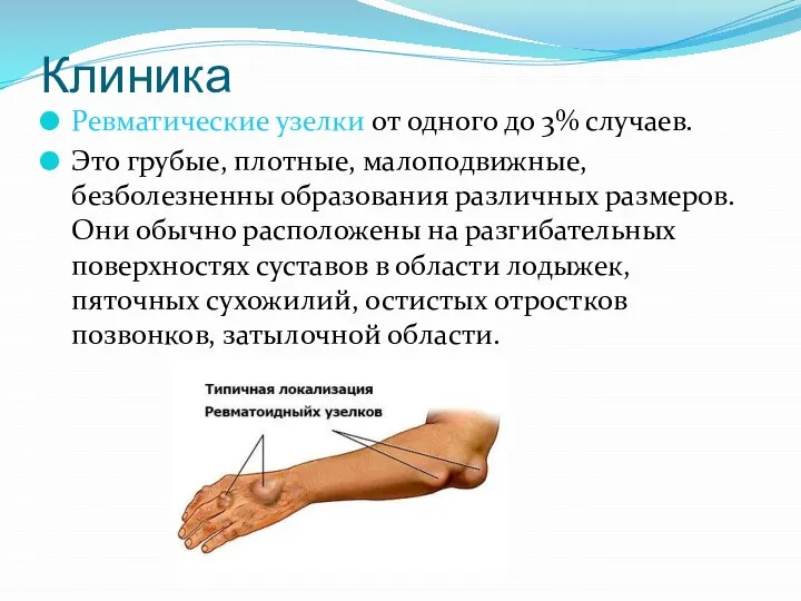 Клиника Ревматические узелки от одного до 3% случаев. Это грубые, плотные, малоподвижные,