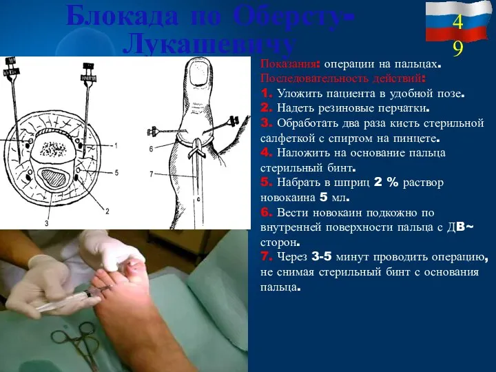 Блокада по Оберсту-Лукашевичу Показания: операции на пальцах. Последовательность действий: 1. Уложить пациента