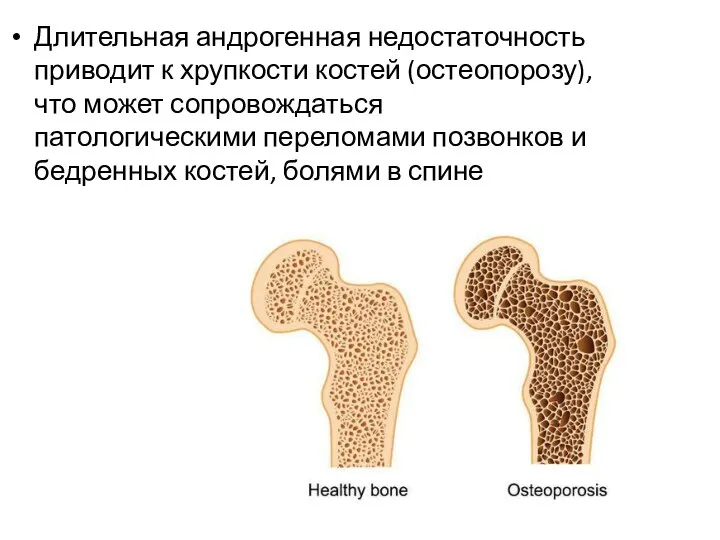 Длительная андрогенная недостаточность приводит к хрупкости костей (остеопорозу), что может сопровождаться патологическими