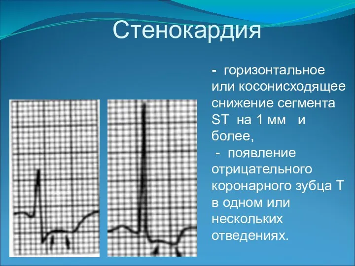 Стенокардия - горизонтальное или косонисходящее снижение сегмента ST на 1 мм и