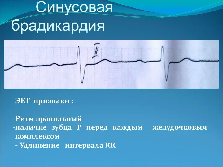 Синусовая брадикардия ЭКГ признаки : Ритм правильный наличие зубца Р перед каждым