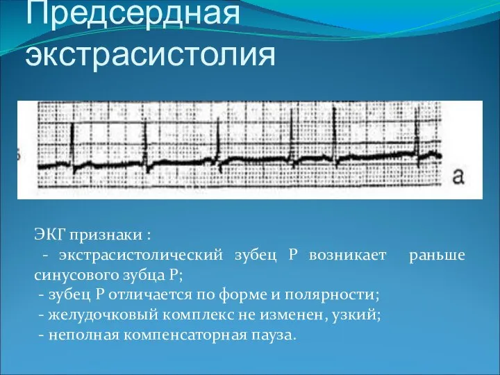 Предсердная экстрасистолия ЭКГ признаки : - экстрасистолический зубец Р возникает раньше синусового