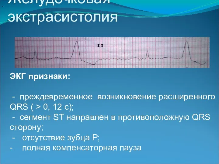 Желудочковая экстрасистолия . ЭКГ признаки: - преждевременное возникновение расширенного QRS ( >