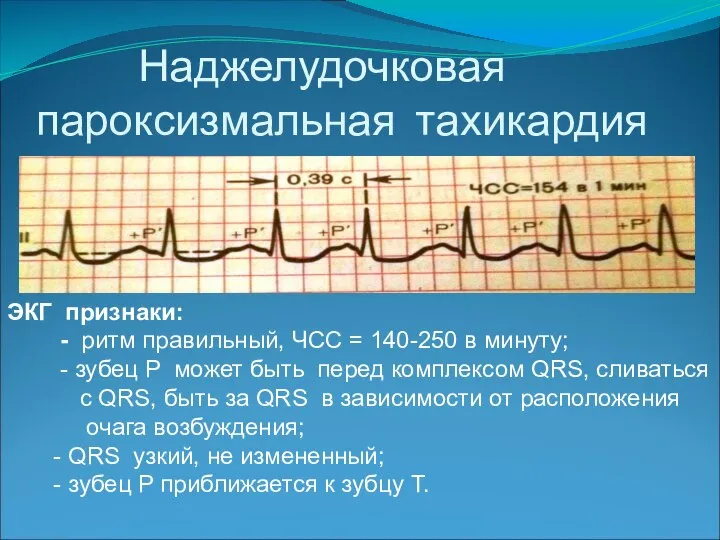 Наджелудочковая пароксизмальная тахикардия ЭКГ признаки: - ритм правильный, ЧСС = 140-250 в