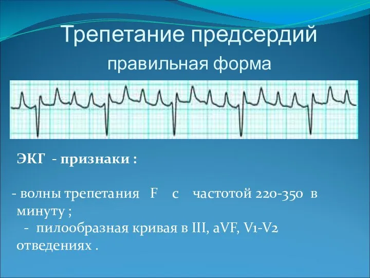 Трепетание предсердий правильная форма ЭКГ - признаки : волны трепетания F c