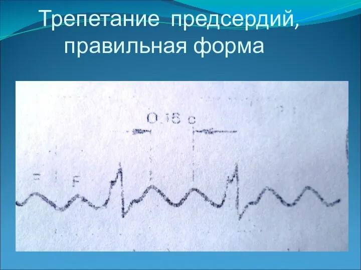 Трепетание предсердий, правильная форма