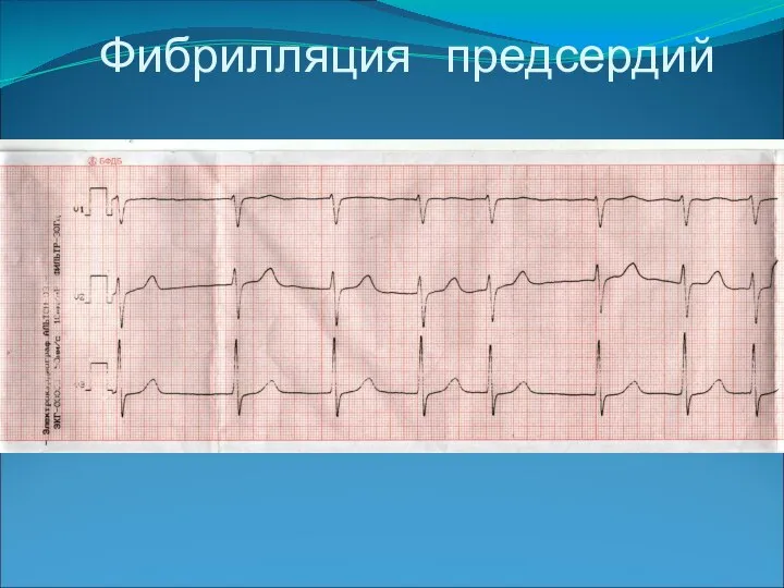 Фибрилляция предсердий