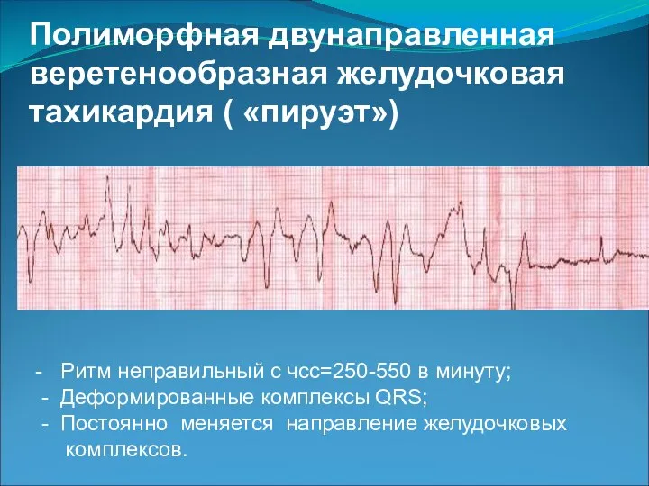 Полиморфная двунаправленная веретенообразная желудочковая тахикардия ( «пируэт») - Ритм неправильный с чсс=250-550