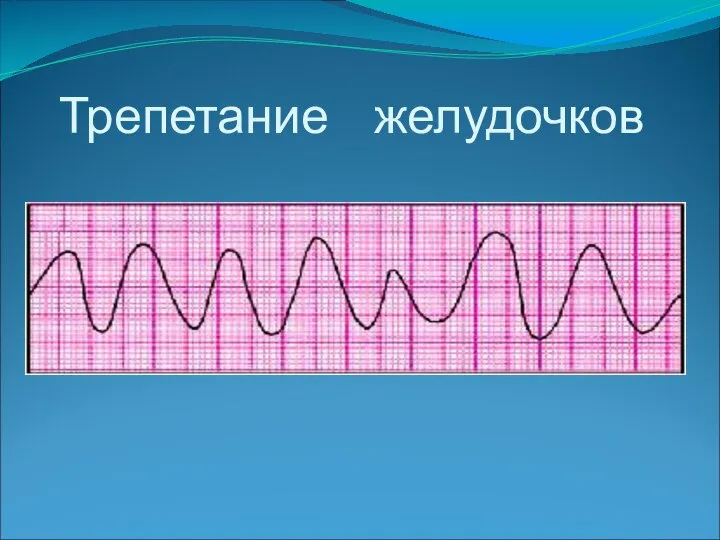 Трепетание желудочков