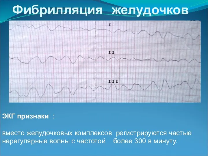 Фибрилляция желудочков ЭКГ признаки : вместо желудочковых комплексов регистрируются частые нерегулярные волны