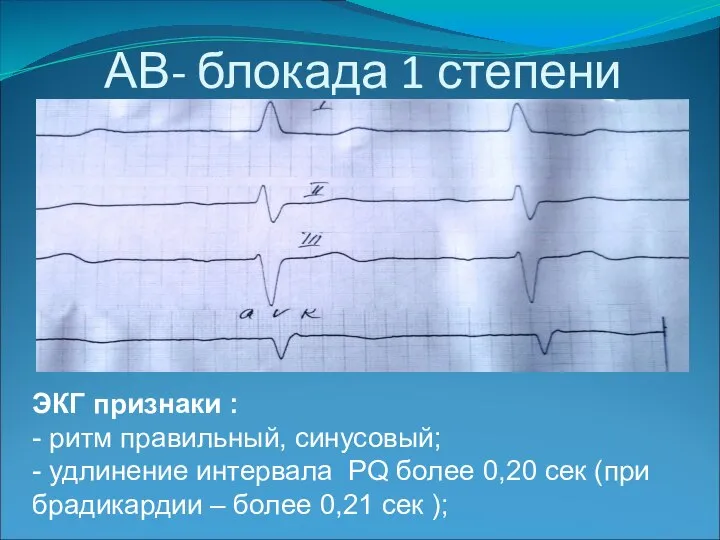 АВ- блокада 1 степени ЭКГ признаки : - ритм правильный, синусовый; -