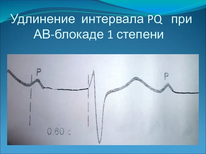 Удлинение интервала PQ при АВ-блокаде 1 степени