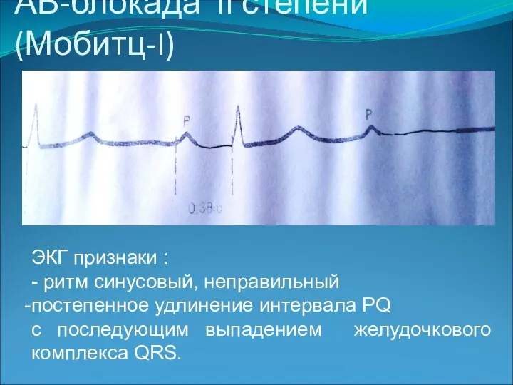 АВ-блокада II степени (Мобитц-I) ЭКГ признаки : - ритм синусовый, неправильный постепенное