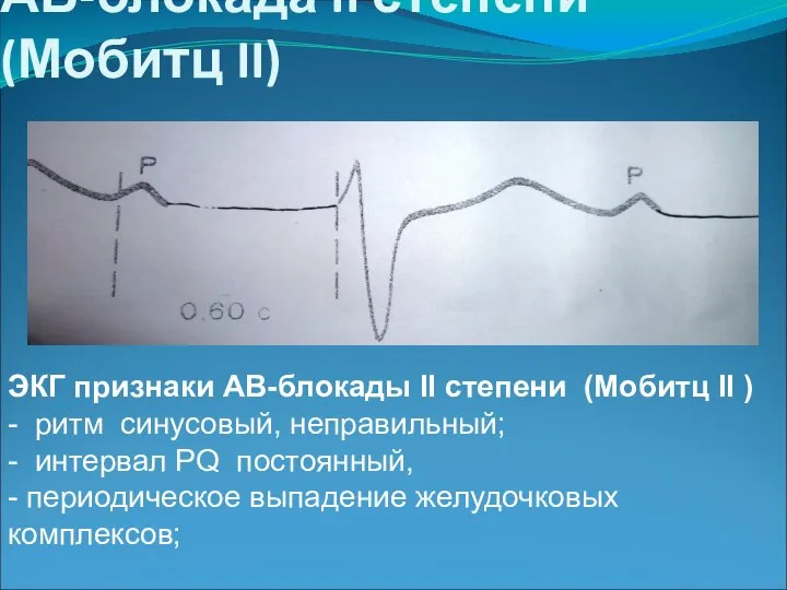 АВ-блокада II степени(Мобитц II) ЭКГ признаки АВ-блокады II степени (Мобитц II )