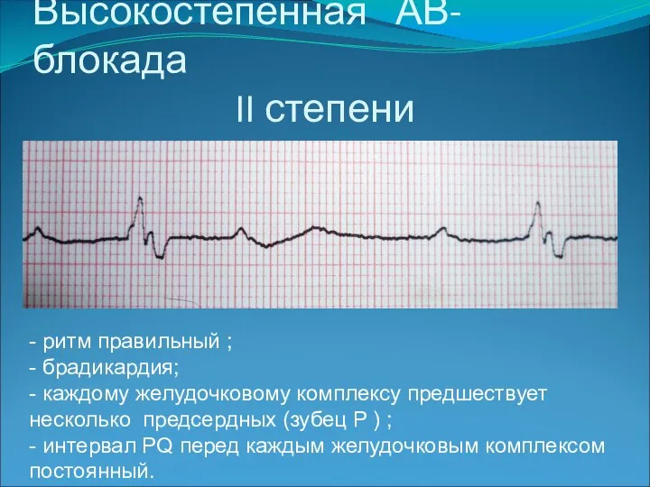 Высокостепенная АВ- блокада II степени - ритм правильный ; - брадикардия; -