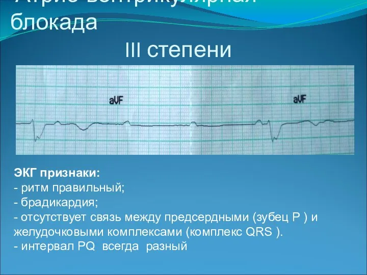 Атрио-вентрикулярная блокада III степени ЭКГ признаки: - ритм правильный; - брадикардия; -