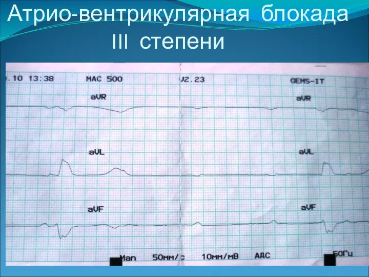 Атрио-вентрикулярная блокада III степени