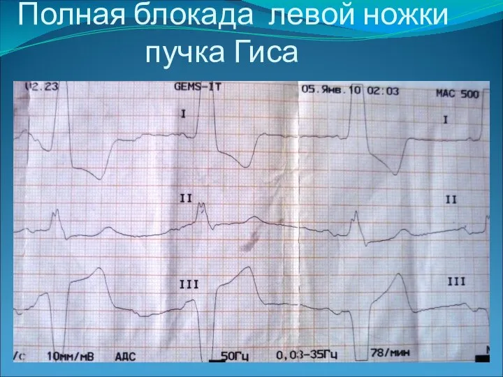 Полная блокада левой ножки пучка Гиса