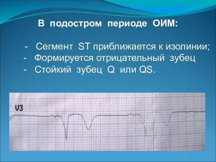 В подостром периоде ОИМ: - Сегмент ST приближается к изолинии; - Формируется