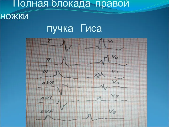 Полная блокада правой ножки пучка Гиса