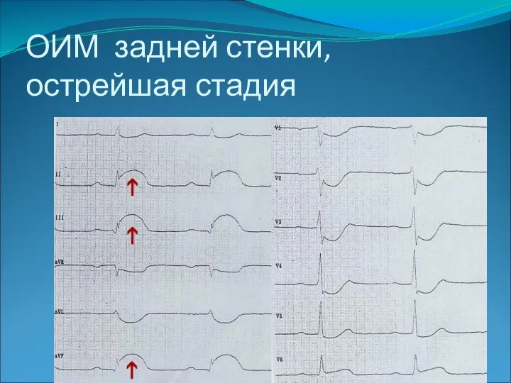 ОИМ задней стенки, острейшая стадия