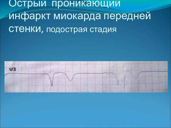 Острый проникающий инфаркт миокарда передней стенки, подострая стадия