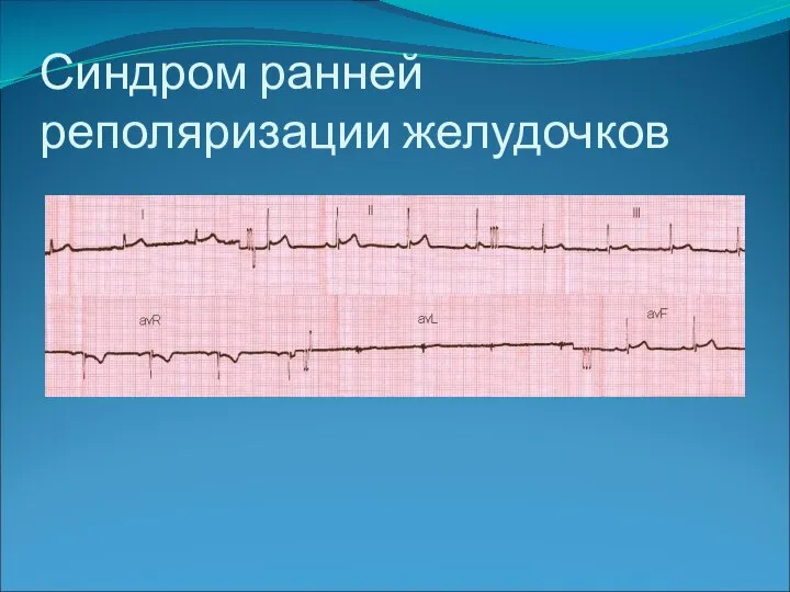 Синдром ранней реполяризации желудочков