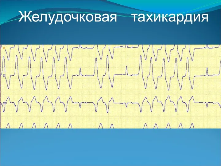 Желудочковая тахикардия