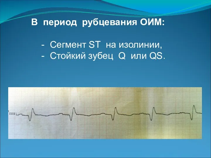 В период рубцевания ОИМ: - Сегмент ST на изолинии, - Стойкий зубец Q или QS.