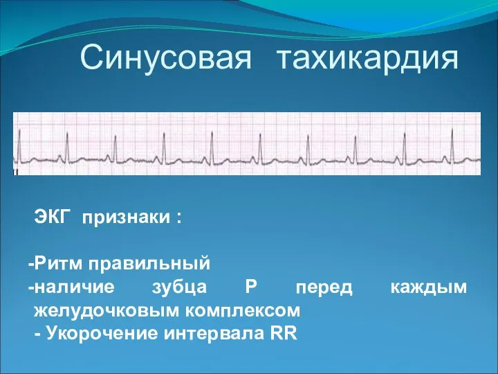 Синусовая тахикардия ЭКГ признаки : Ритм правильный наличие зубца Р перед каждым