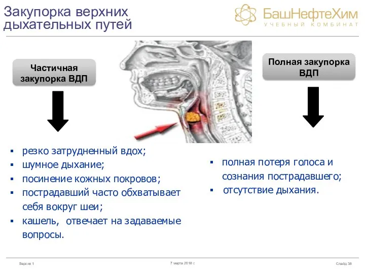 Закупорка верхних дыхательных путей Слайд 7 марта 2018 г. Частичная закупорка ВДП