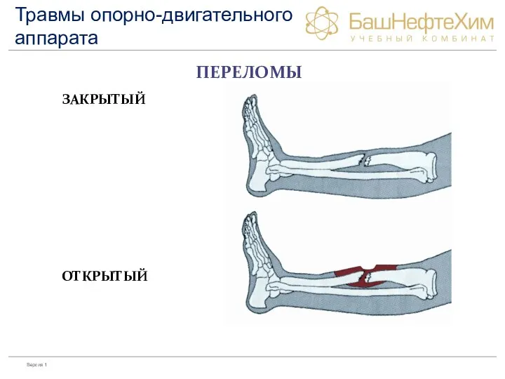 ПЕРЕЛОМЫ ЗАКРЫТЫЙ ОТКРЫТЫЙ Травмы опорно-двигательного аппарата