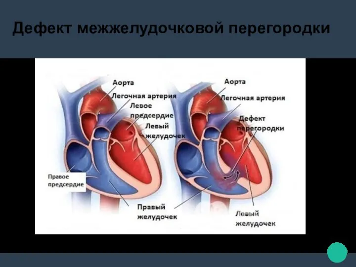 Дефект межжелудочковой перегородки