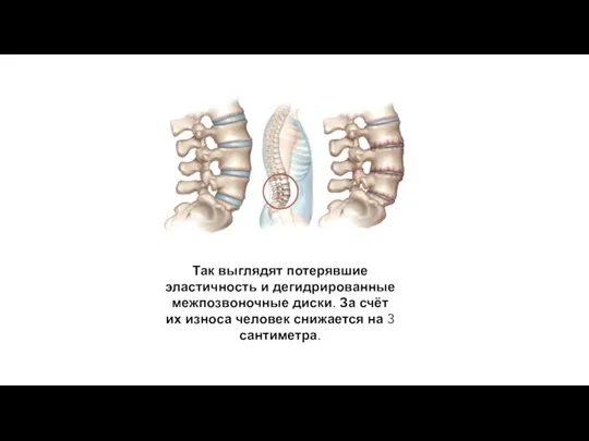 Так выглядят потерявшие эластичность и дегидрированные межпозвоночные диски. За счёт их износа