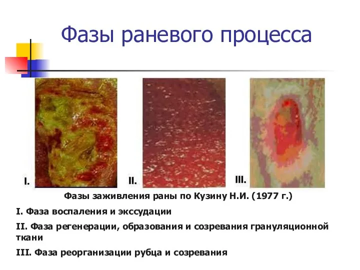 Фазы раневого процесса Фазы заживления раны по Кузину Н.И. (1977 г.) І.