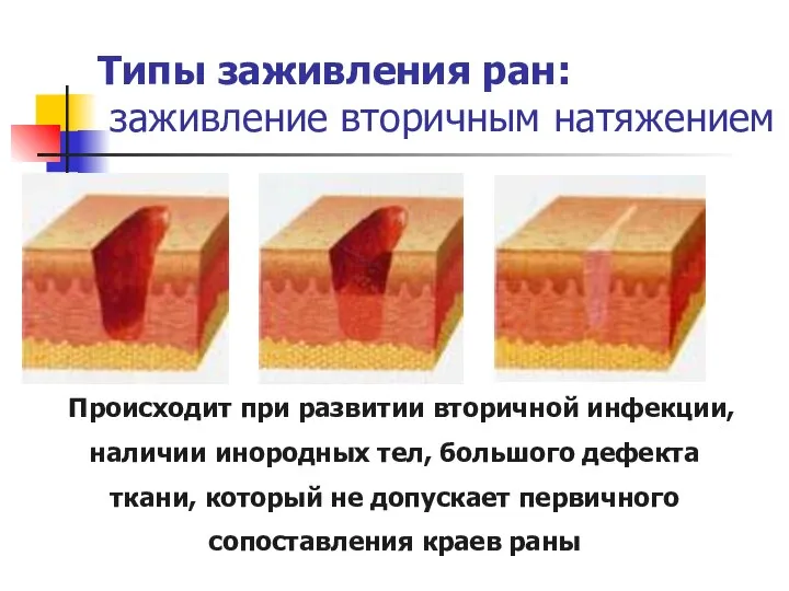 Типы заживления ран: заживление вторичным натяжением Происходит при развитии вторичной инфекции, наличии