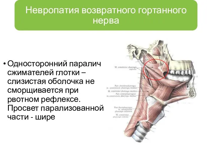 Односторонний паралич сжимателей глотки – слизистая оболочка не сморщивается при рвотном рефлексе.