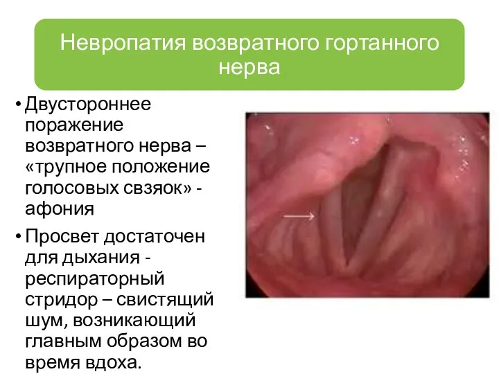 Двустороннее поражение возвратного нерва – «трупное положение голосовых свзяок» - афония Просвет