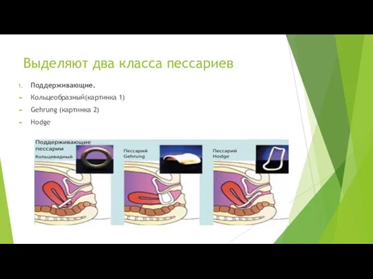 Выделяют два класса пессариев Поддерживающие. Кольцеобразный(картинка 1) Gehrung (картинка 2) Hodge