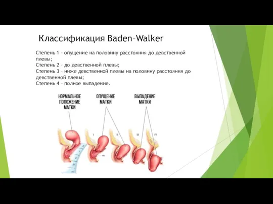 Классификация Baden–Walker Степень 1 – опущение на половину расстояния до девственной плевы;