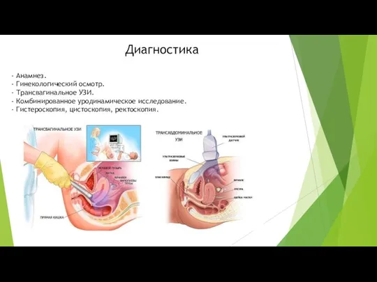 Диагностика - Анамнез. - Гинекологический осмотр. - Трансвагинальное УЗИ. - Комбинированное уродинамическое