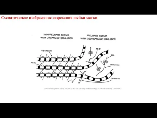 Схематическое изображение созревания шейки матки Clin Obstet Gynecol. 1995 Jun;38(2):267-79, Anatomy and