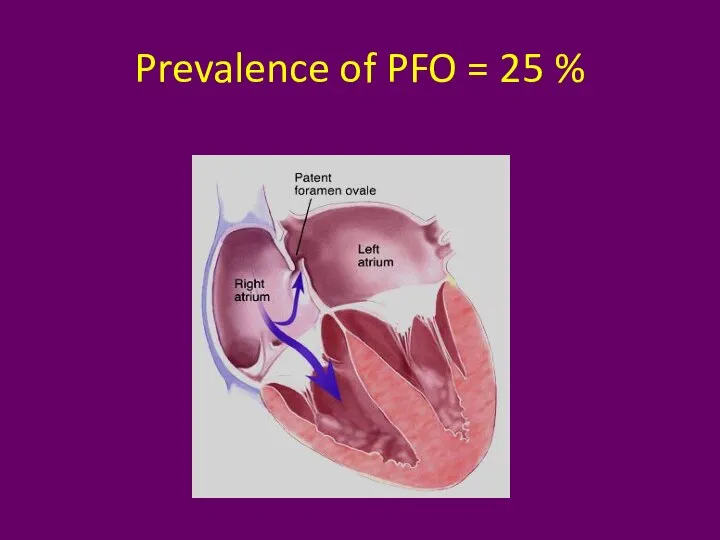 Prevalence of PFO = 25 %