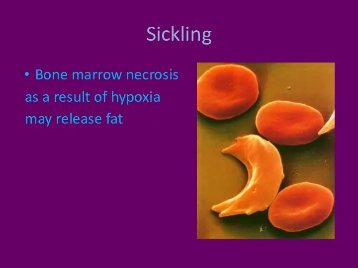 Sickling Bone marrow necrosis as a result of hypoxia may release fat