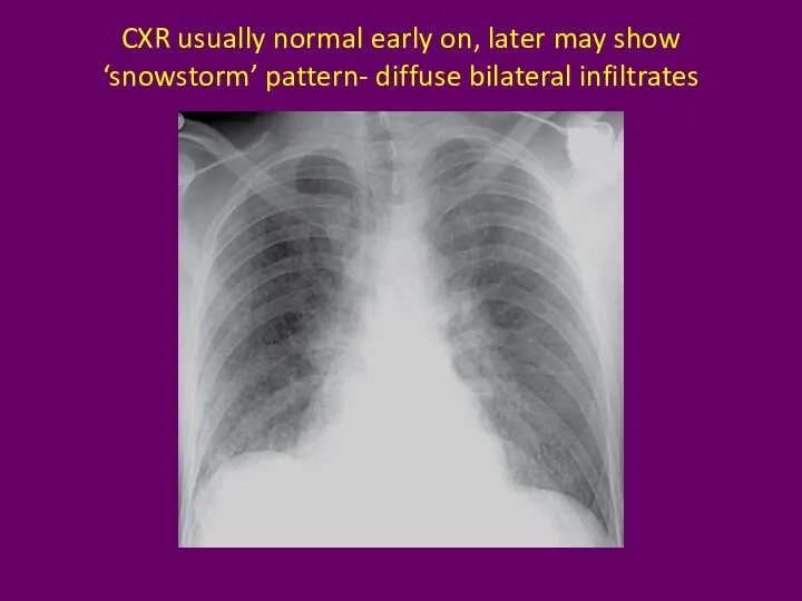 CXR usually normal early on, later may show ‘snowstorm’ pattern- diffuse bilateral infiltrates