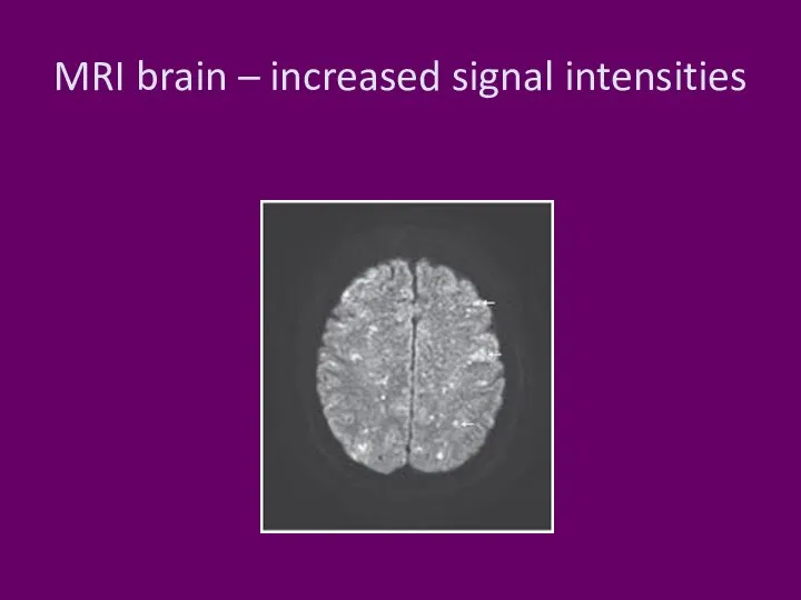 MRI brain – increased signal intensities