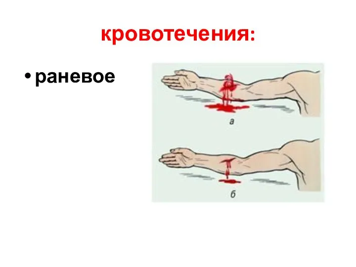 кровотечения: раневое