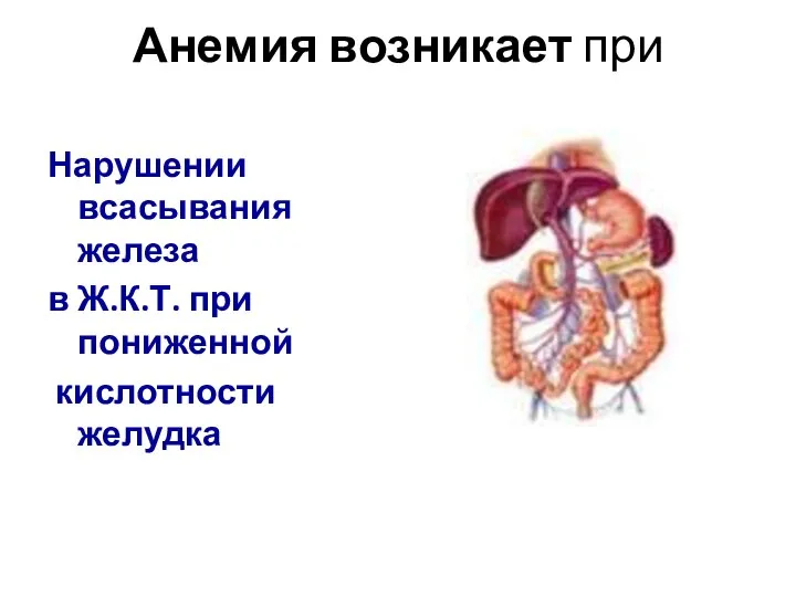 Анемия возникает при Нарушении всасывания железа в Ж.К.Т. при пониженной кислотности желудка