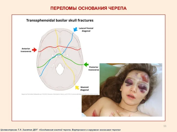 ПЕРЕЛОМЫ ОСНОВАНИЯ ЧЕРЕПА Цехмистренко Т.А. Занятие ДОТ «Соединения костей черепа. Внутреннее и наружное основание черепа»