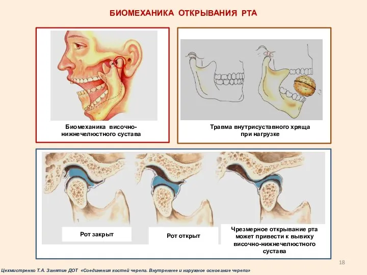 Биомеханика височно-нижнечелюстного сустава Травма внутрисуставного хряща при нагрузке Рот закрыт Рот открыт